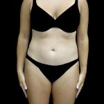 Liposuction Before & After Patient #25016