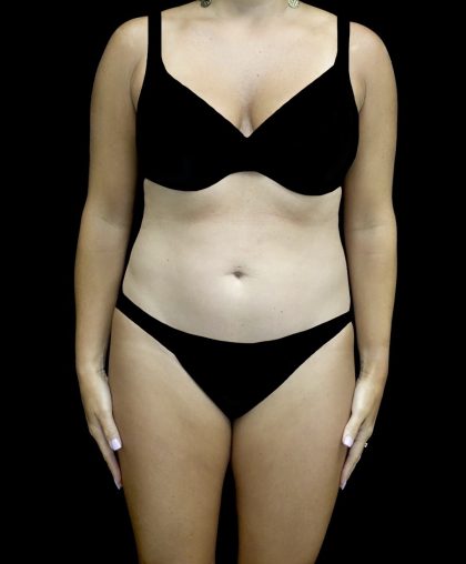 Liposuction Before & After Patient #25016