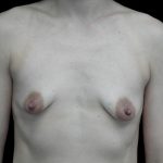 Breast Augmentation (Implants) Before & After Patient #25026
