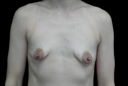 Breast Augmentation (Implants) Before & After Patient #25026