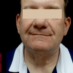 Facelift & Necklift Before & After Patient #24963