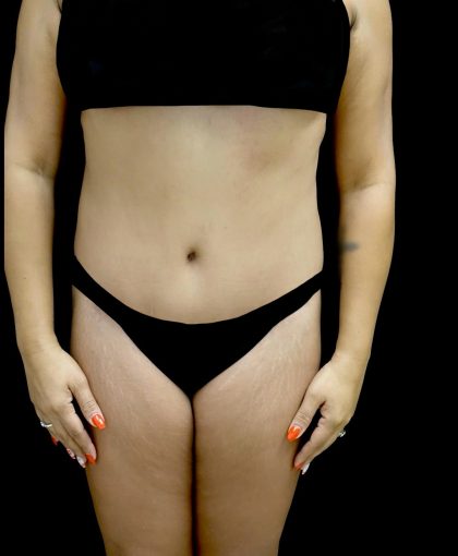 Liposuction Before & After Patient #24973