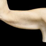 Brachioplasty Before & After Patient #24987