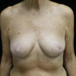 Breast Reduction Before & After Patient #24997