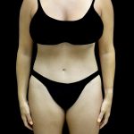 Liposuction Before & After Patient #25016