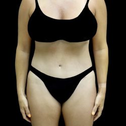 Liposuction Before & After Patient #25016