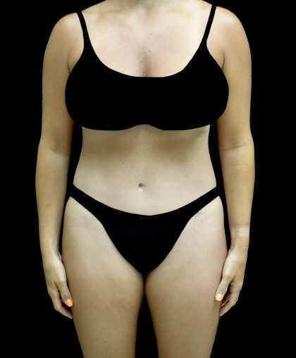 Liposuction Before & After Patient #25016