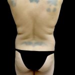 Liposuction Before & After Patient #24973