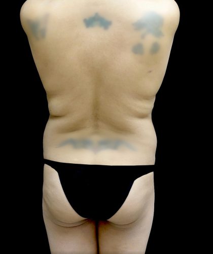 Liposuction Before & After Patient #24973