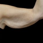Brachioplasty Before & After Patient #24987