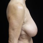 Breast Reduction Before & After Patient #24997