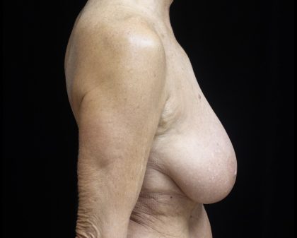 Breast Reduction Before & After Patient #24997
