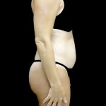 Liposuction Before & After Patient #25016