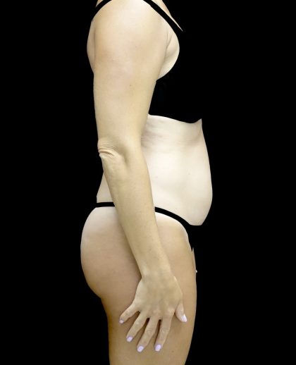 Liposuction Before & After Patient #25016