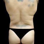 Liposuction Before & After Patient #24973