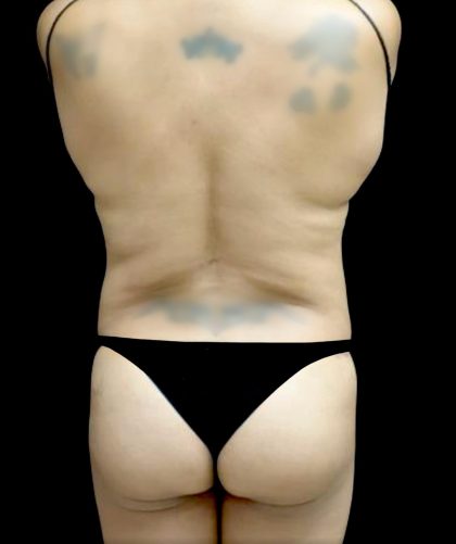 Liposuction Before & After Patient #24973