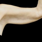 Brachioplasty Before & After Patient #24987