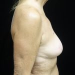 Breast Reduction Before & After Patient #24997