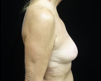 Breast Reduction Before & After Patient #24997