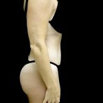 Liposuction Before & After Patient #25016