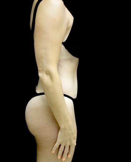 Liposuction Before & After Patient #25016
