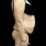 Liposuction Before & After Patient #24973