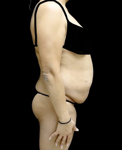 Liposuction Before & After Patient #24973