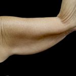 Brachioplasty Before & After Patient #24987