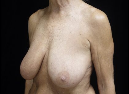 Breast Reduction Before & After Patient #24997