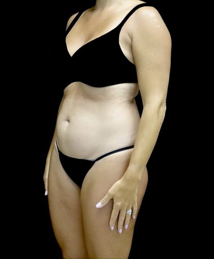 Liposuction Before & After Patient #25016
