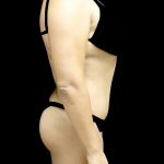 Liposuction Before & After Patient #24973