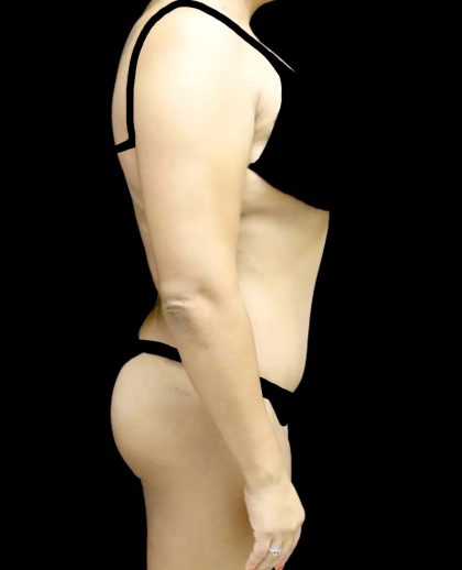 Liposuction Before & After Patient #24973