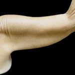 Brachioplasty Before & After Patient #24987