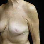 Breast Reduction Before & After Patient #24997