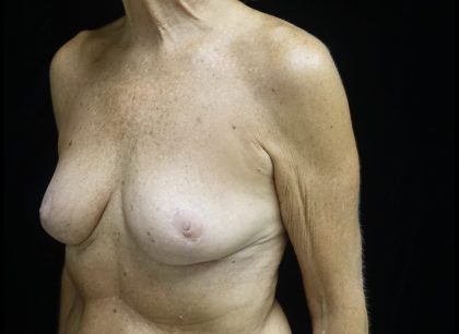 Breast Reduction Before & After Patient #24997