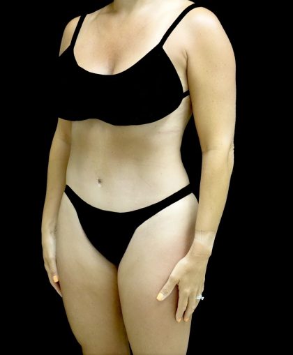 Liposuction Before & After Patient #25016