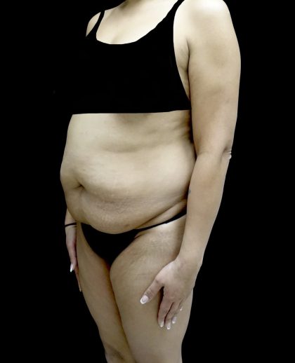 Liposuction Before & After Patient #24973