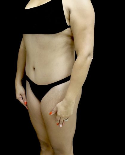 Liposuction Before & After Patient #24973