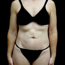 Tummy Tuck Before & After Patient #24930