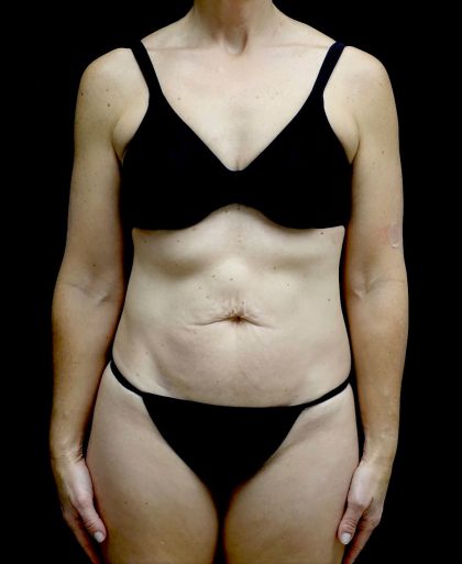 Tummy Tuck Before & After Patient #24930