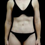Tummy Tuck Before & After Patient #24930