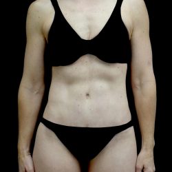Tummy Tuck Before & After Patient #24930