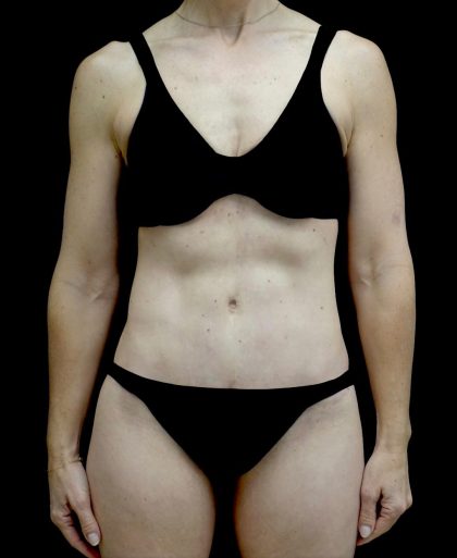 Tummy Tuck Before & After Patient #24930