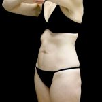 Tummy Tuck Before & After Patient #24930