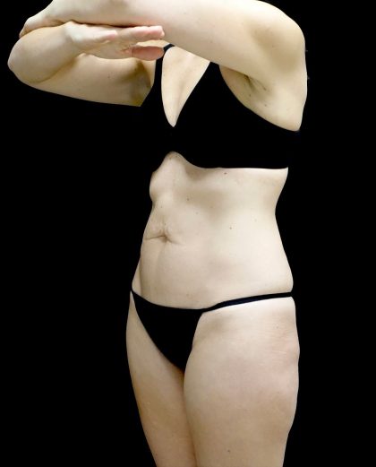 Tummy Tuck Before & After Patient #24930