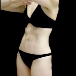 Tummy Tuck Before & After Patient #24930