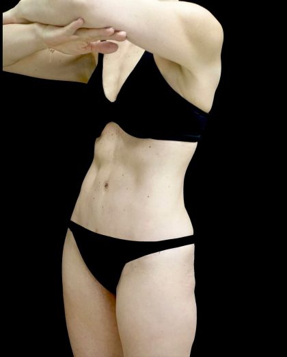 Tummy Tuck Before & After Patient #24930
