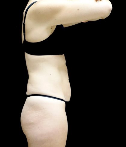 Tummy Tuck Before & After Patient #24930