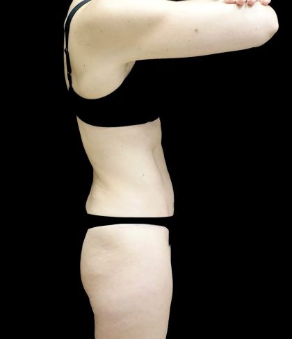 Tummy Tuck Before & After Patient #24930