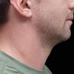 Chin Implants (Augmentation) Before & After Patient #24946